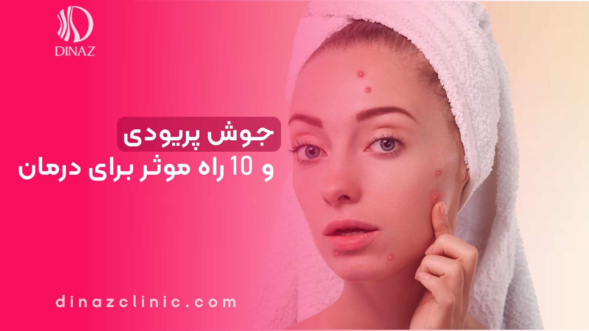 جوش پریودی و 10 راه موثر برای درمان