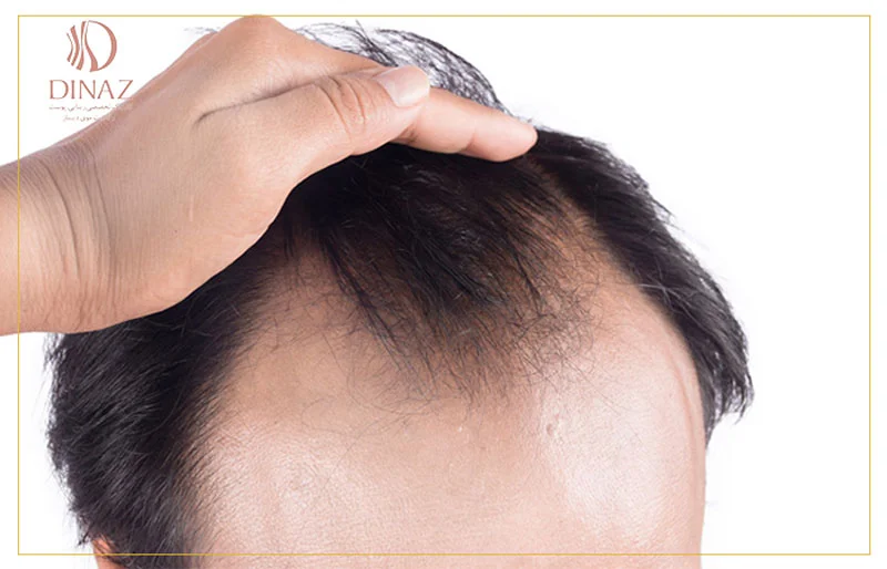 ریزش مو با الگوی مردانه چطور است ؟
