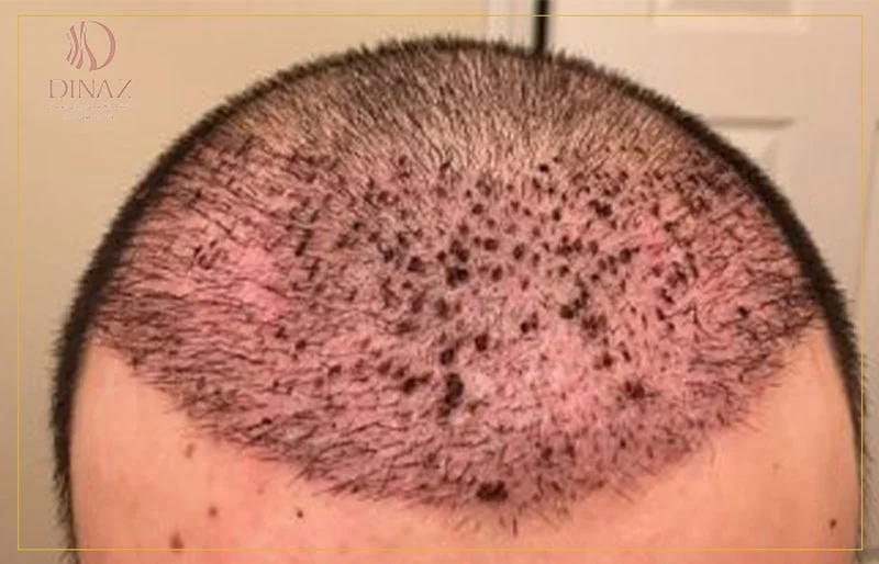 علل عفونت پس از کاشت مو