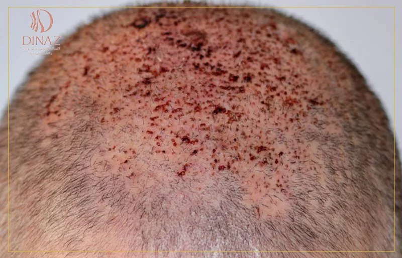 علائم عفونت پس از کاشت مو