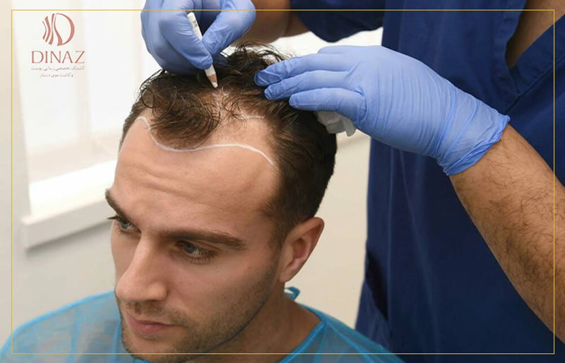 خط کشی مو سر یک آقا برای تعیین فصل مناسب کاشت مو