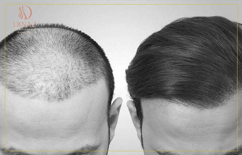 قبل و بعد از کاشتن مو برای یک آقا