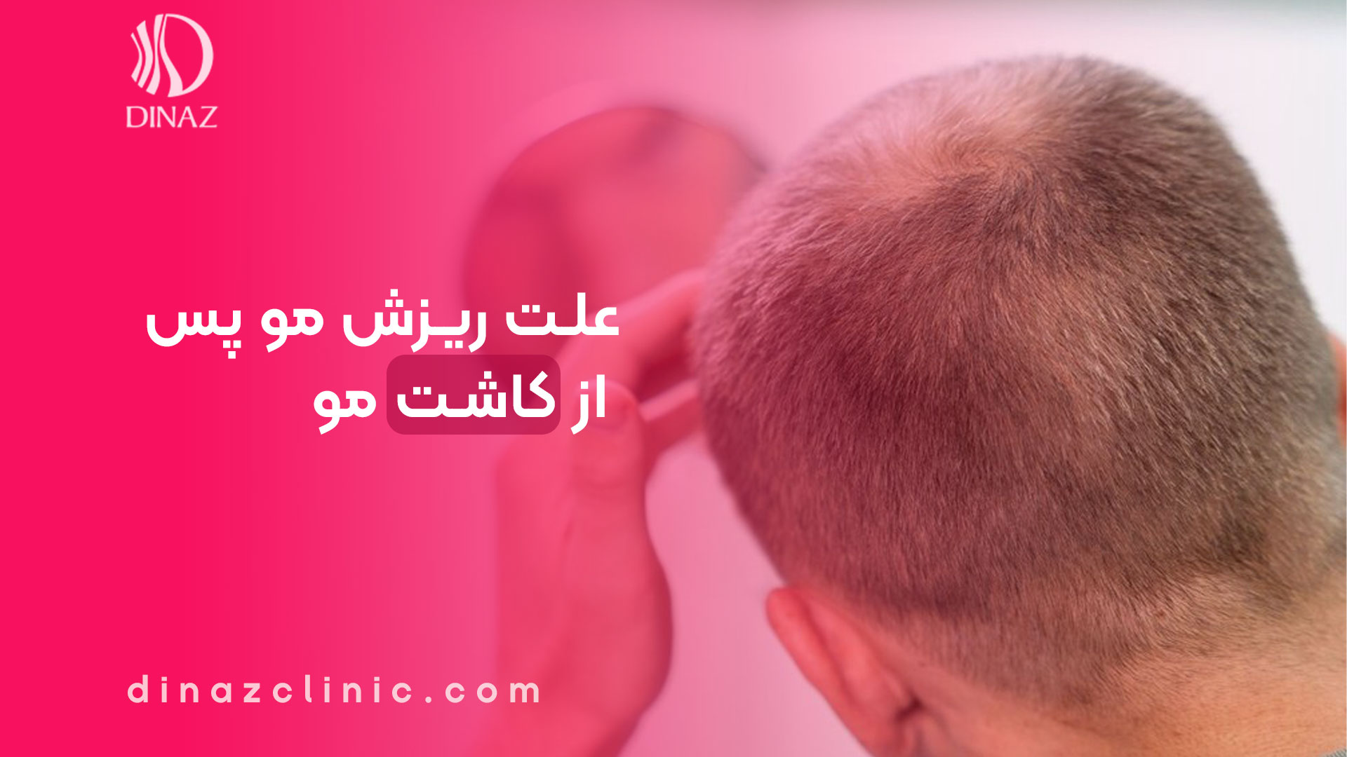 علت ریزش مو پس از کاشت مو